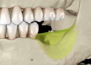 Alveolar bone loss after tooth extraction
