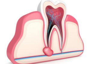 Preventing tooth abscess