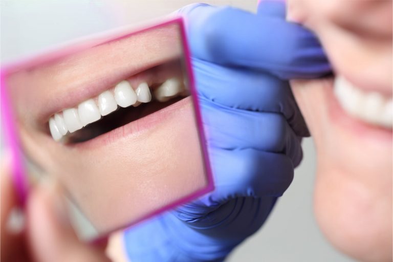 What Happens to the Jawbone After Tooth Extraction