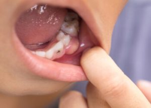 Jaw infections
