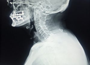 bone spurs in neck cause facial swelling x-ray