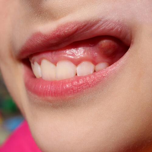 Hard Bony Lump on Gum Symptoms, and Treatments Premier Ortho